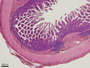 ileum_ca_4x